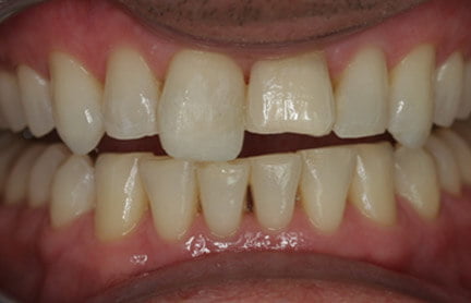 The front teeth were added to to increase the length.