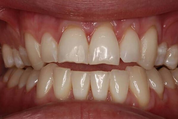 Minor chips and reduced tooth length.