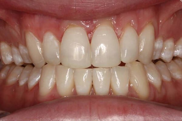 Front teeth rebuilt with bonded resin.