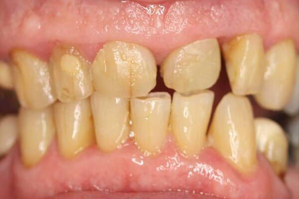Chipped damaged teeth.