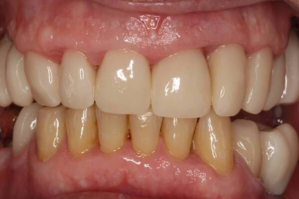 Reconstructed correct bite with ceramic.