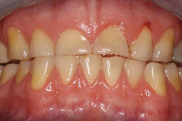 tooth wear bruxism treatment excessive due pre dentist