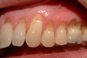 abrasion