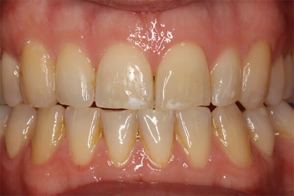 Teeth aligned in 4 months. Final result.