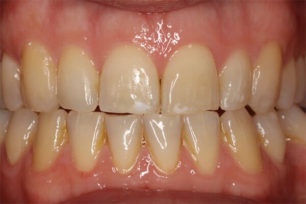 teeth braces aligned fastbraces result months final
