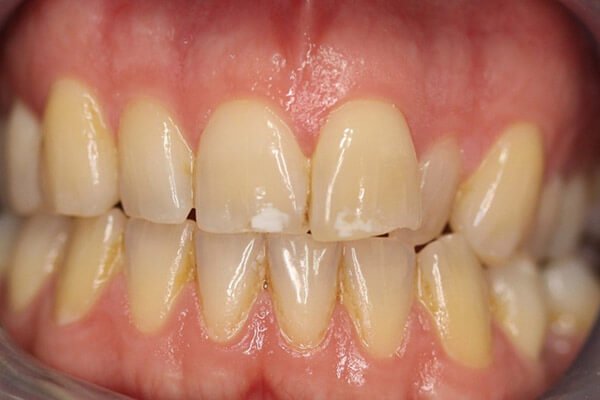 Pre treatment situation