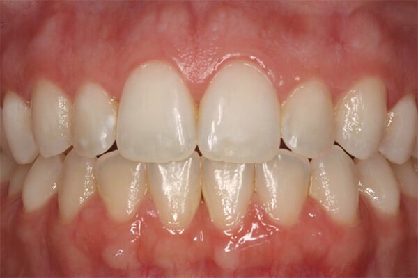A fast brace is removed and retainers fitted.