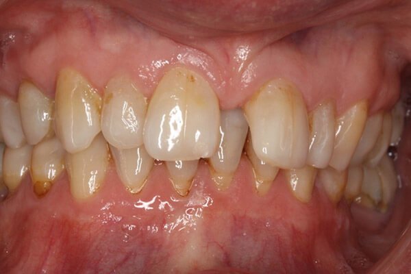 The gap was slowly increasing as teeth move forward.
